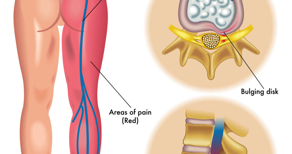 Back of the Knee Vein And Pain Natural Remedies