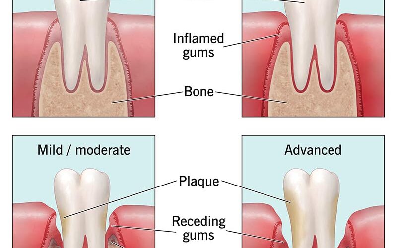 Diseases That Affect the Gums around the Teeth