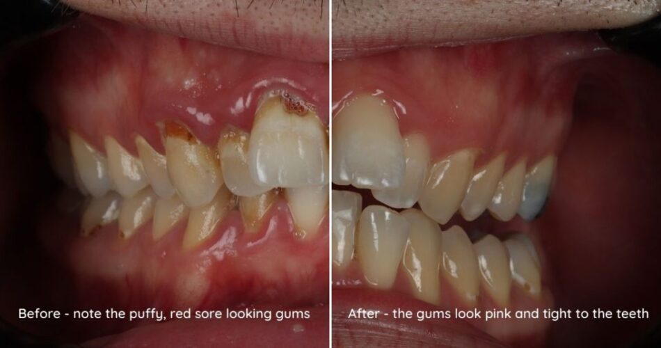 Gum Disease Look Like