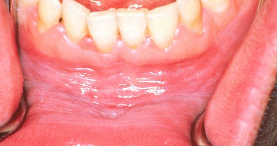 My Gums are White