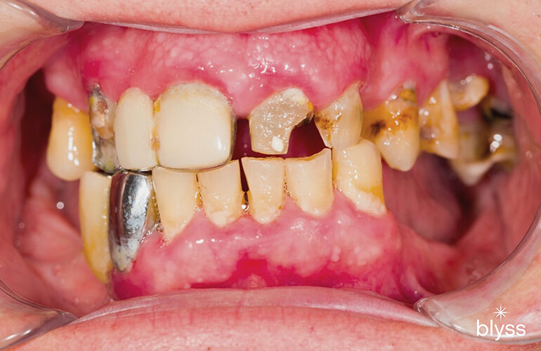 Teeth Diseases